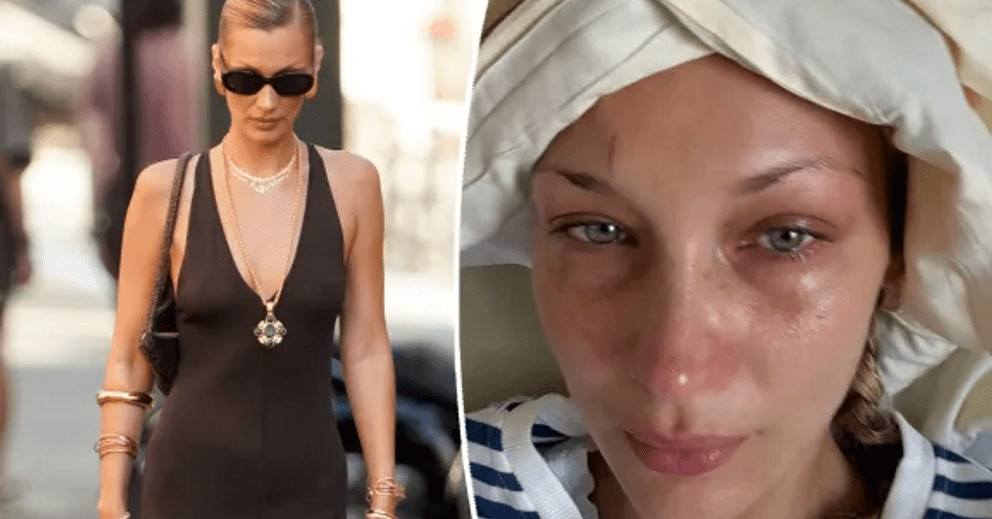 Bella Hadid đau đớn, tàn tạ không nhận ra khi bệnh nặng tái phát缩略图