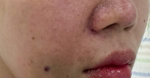 Cô gái bị tắc mạch, hoại tử sau khi tiêm filler làm đầy rãnh cười ở spa缩略图