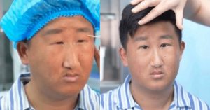 Đôi mắt sau cắt mí của nam thanh niên gây tranh cãi vì &amp;apos;trước sau như một&amp;apos;: Đánh giá của bác sĩ gây bão MXH缩略图