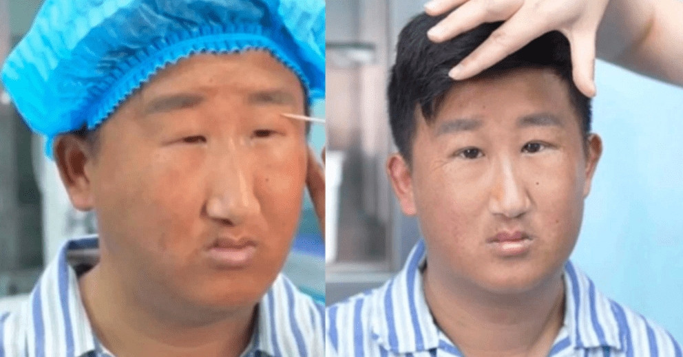 Đôi mắt sau cắt mí của nam thanh niên gây tranh cãi vì 'trước sau như một': Đánh giá của bác sĩ gây bão MXH缩略图 Đôi mắt sau cắt mí của nam thanh niên gây tranh cãi vì 'trước sau như một': Đánh giá của bác sĩ gây bão MXH缩略图